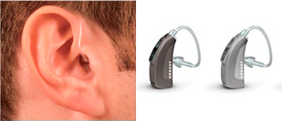 Quando um aparelho auditivo retroauricular é indicado